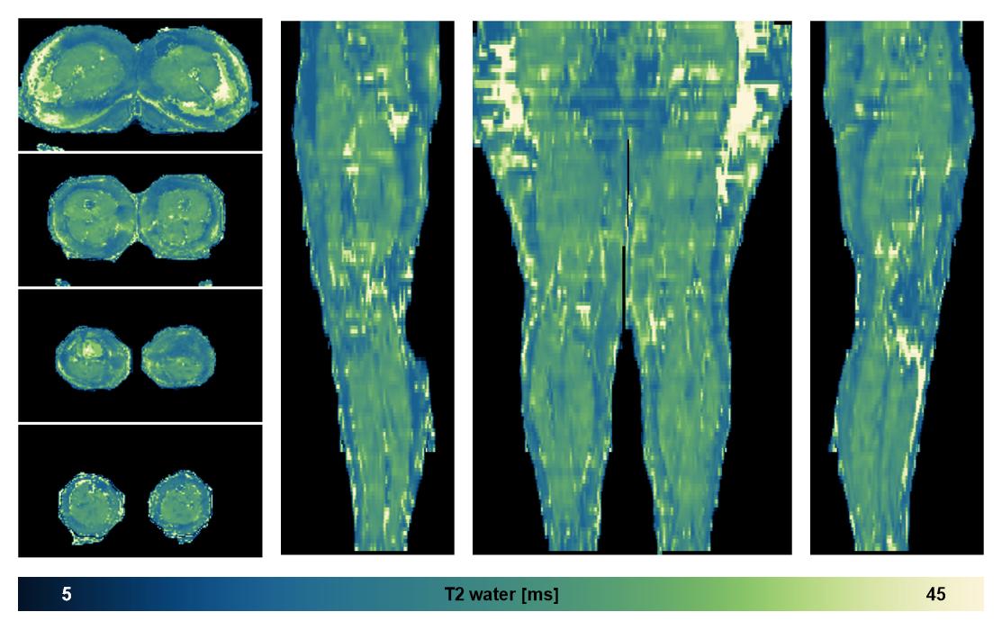 The water only T2 relaxation time of the lower extremity obtained from multi echo spin echo t2 mapping with EPG based reconstruction.